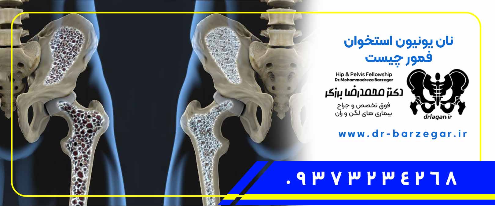 9567-nonunion-فوق-تخصص-درمان-جوش-نخوردن-شکستگی-استخوان-گردن-فمور-نان-یونیون-فمور-femor، انواع شکستگی گردن فمور, برای جوش خوردن شکستگی استخوان چی بخوریم, بهترین جراح ارتوپد لگن, بهترین جراح ارتوپد لگن تهران, پیوند استخوان, پیوند استخوان از لگن, پیوند استخوان از لگن به ساق پا, پیوند استخوان از لگن به فک, پیوند استخوان پا, پیوند استخوان تنه ران, پیوند استخوان چگونه انجام میشود, پیوند استخوان چیست, پیوند استخوان دندان برای ایمپلنت, پیوند استخوان ران, پیوند استخوان ران به فک, پیوند استخوان ران چگونه انجام میشود, پیوند استخوان سر فمور, پیوند استخوان فمور, پیوند استخوان فمورد, پیوند استخوان فموری, پیوند استخوان لگن, پیوند استخوان لگن برای ایمپلنت, پیوند استخوان لگن به فک, پیوند استخوان لگن به لثه, پیوند استخوان لگن به مچ دست, پیوند استخوان لگن چیست, پیوند استخوان مفصل ران, جراح ارتوپد فوق تخصص لگن, جراح ارتوپد لگند, جراح ارتوپد لگنو, جراح ارتوپد لگنی, جراح متخصص ارتوپد لگن, جراحی ارتوپد لگن, جراحی ارتوپدی لگن, جراحی شکستگی گردن فمور, جوش خوردن استخوان, جوش خوردن استخوان پا, جوش خوردن استخوان متاتارس پنجم, جوش خوردن شکستگی استخوان, جوش خوردن شکستگی استخوان بازو, جوش خوردن شکستگی استخوان در طب سنتی, جوش نخوردگی استخوانی, جوش نخوردن استخوان, جوش نخوردن استخوان بازو, جوش نخوردن استخوان بینی, جوش نخوردن استخوان ترقوه, جوش نخوردن استخوان ساق پا, جوش نخوردن استخوان شکسته, جوش نخوردن استخوان متاتارس, درمان جوش خوردن شکستگی استخوان, درمان شکستگی فمور, درمان شکستگی فمور بدون جراحی, درمان شکستگی فمور لگن, درمان شکستگی گردن فمور, درمان نانیونیون اصفهان, درمان نانیونیون چیست, درمانان یونیون استخواند, درمانان یونیون استخوانی, دیه پیوند استخوان ران, زمان جوش خوردن شکستگی استخوان, شکستگی استخوان گردن فمور, شکستگی فمور, شکستگی فمور پا, شکستگی فمور پلاتین, شکستگی فمور چیست, شکستگی فمور در جوانان, شکستگی فمور در سالمندان, شکستگی فمور در کودکان, شکستگی فمور لگن, شکستگی فمور نی نی سایت, شکستگی فمورال, شکستگی گردن فمور, شکستگی گردن فمور در افراد مسن, شکستگی گردن فمور لگن, شکستگی گردن فمور مقاله, شکستگی های گردن فمور, علائم جوش خوردن شکستگی استخوان, علائم جوش نخوردن شکستگی استخوان, علت جوش نخوردن استخوان, علت جوش نخوردن استخوان انگشت پا, علت جوش نخوردن استخوان بازو, علت جوش نخوردن استخوان ترقوه, علت جوش نخوردن استخوان ران, علت جوش نخوردن استخوان ساق پا, علت جوش نخوردن استخوان شکسته, علت جوش نخوردن استخوان کف پا, علت جوش نخوردن استخوان مچ دست, علت جوش نخوردن استخوان نازک نی پا, عمل پیوند استخوان ران, عمل پیوند استخوان ران پا, عمل جراحی شکستگی فمور, عمل شکستگی استخوان فمور, عمل شکستگی ران, عمل شکستگی ران پا, عمل شکستگی ران نی نی سایت, عمل شکستگی ران و لگن, عمل شکستگی فمور, عمل شکستگی گردن فمور, عمل مجدد لگنی, عوارض جوش نخوردن شکستگی استخوان, عوارض شکستگی گردن فمور, عوارض عمل شکستگی فمور, فوق تخصص جراح لگن, فوق تخصص جراحي سينه در تهران, فوق تخصص جراحی لگن, فوق تخصص جراحی لگن اصفهان, فوق تخصص جراحی لگن تهران, فوق تخصص جراحی لگن در اصفهان, فوق تخصص جراحی لگن در تبریز, فوق تخصص جراحی لگن در شیراز, فوق تخصص جراحی لگن در مشهد, فوق تخصص جراحی لگن و زانو, فیزیوتراپی شکستگی گردن فمور, فیلم پیوند استخوان از لگن, فیلم پیوند استخوان ران, مراحل جوش خوردن شکستگی استخوان, مراقبت بعد از شکستگی فمور, مراقبت بعد از عمل شکستگی فمور, مراقبت بعد از عمل شکستگی گردن فمور, مراقبت بعد عمل شکستگی ران, مراقبت پرستاری در شکستگی فمور, مراقبت پرستاری شکستگی فمور, مراقبت شکستگی فمور, مراقبت های بعد از عمل شکستگی ران, مراقبت های بعد از عمل شکستگی فمور, مراقبت های پرستاری شکستگی فمور, مراقبت های شکستگی فمور, مراقبتهای بعد از عمل شکستگی استخوان ران, مراقبتهای بعد از عمل شکستگی گردن فمور, نان یونیون, نان یونیون استخوان اصفهان, نان یونیون استخوان فمورد, نان یونیون استخوان فموری, نان یونیون استخوانی, نان یونیون فمور, نان یونیون فمورد, نان یونیون فموری, نانیونیون استخوانی, نشانه جوش خوردن شکستگی استخوان, هزینه پیوند استخوان ران