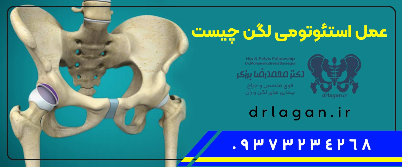 9575-ganz--در-اصفهاناستئوتومی-لگن-ران-هیپ-استئوتومی-لگن-عمل-جراحی-گانز-Ganz-استابولوم-osteotomy، ganz osteotomy, ganz osteotomy approach, ganz osteotomy cpt, ganz osteotomy cpt code, ganz osteotomy for ddh, ganz osteotomy indications, ganz osteotomy orthobullets, ganz osteotomy protocol, ganz osteotomy recovery, ganz osteotomy surgical technique, pelvic osteotomy, pelvic osteotomy bladder exstrophy, pelvic osteotomy child, pelvic osteotomy dog, pelvic osteotomy for ddh, pelvic osteotomy in adults, pelvic osteotomy orthobullets, pelvic osteotomy ppt, pelvic osteotomy recovery time, pelvic osteotomy types, استئوتومی استابولومبی, استئوتومی استابولومی, استئوتومی استخوان ران, استئوتومی ران, استئوتومی گانزده, استئوتومی لگن, استئوتومی لگن چیست, استئوتومی لگنا, استئوتومی لگنت, استئوتومی لگنو, استئوتومی لگنی, استئوتومی مفصل ران, استئوتومی هیپ, استابولوم استئوتومیز, استابولوم استئوتومیزی, استابولوم استئوتومیک, استابولوم استئوتومیم, جراحی استئوتومی ران, جراحی استئوتومی لگن, جراحی استئوتومی لگنی, جراحی استئوتومی لگنیا, جراحی استئوتومی لگنیت, خطرات استئوتومیز, درمان استئوتومی, درمان استئوتومیز, درمان استئوتومیزی, درمان استئوتومیک, درمان استئوتومیم, ران استئوتومیار, ران استئوتومیز, ران استئوتومیک, ران استئوتومیم, عظم الفخذ, عظم الفخذ اسم, عظم الفخذ الانسان, عظم الفخذ العلوي, عظم الفخذ اين يوجد, عظم الفخذ بالانجليزي, عظم الفخذ تشريح, عظم الفخذ عند الانسان, عظم الفخذ للجنين, عظم الفخذ يؤلمني, عمل استئوتومی ران, عمل استئوتومی لگن, عمل استئوتومی لگنا, عمل استئوتومی لگنو, عمل استئوتومی لگنی, عمل جراحی استئوتومی لگن, عوارض استئوتومی لگنا, عوارض استئوتومی لگنی, فیلم عمل استئوتومی لگن, قطع عظم استابولومی, قطع عظم الحوضه, قطع عظم الحوضي, قطع عظم الحوضی, قطع عظم الحوضیه, قطع عظم الفخذی, قطع عظم جانزاده, قطع عظم جانزد, قطع عظم جانزده, قطع عظم جانزدی, لگن استئوتومیز, لگن استئوتومیک, لگن استئوتومیم, مراقبت استئوتومی ایران, مراقبت استئوتومی بد, مراقبت استئوتومی دیوار, مراقبت استئوتومی مردانه, مراقبت های عمل استئوتومی, هیپ استئوتومیز, هیپ استئوتومیزی, هیپ استئوتومیک, هیپ استئوتومیم
